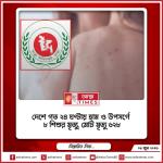 দেশে গত ২৪ ঘণ্টায় হাম ও উপসর্গে ৮ শিশুর মৃত্যু, মোট মৃত্যু ৬২৮